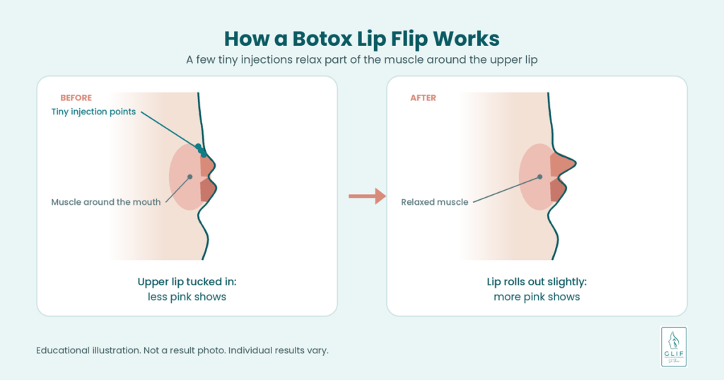how botox lip flip treatment works